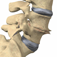 mLumbarDegenerativeDiscDisease